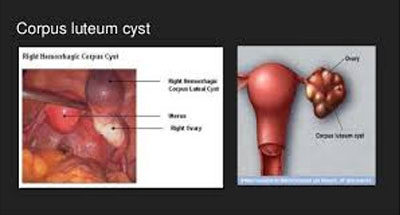 Corpus luteum cysts