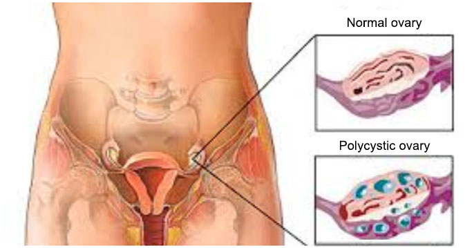 Polycystic Ovary Disease-PCOD-Dr-Qaisar-Ahmed-dixe-cosmetics